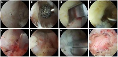 Decompression via unilateral biportal endoscopy for severe degenerative lumbar spinal stenosis: A comparative study with decompression via open discectomy